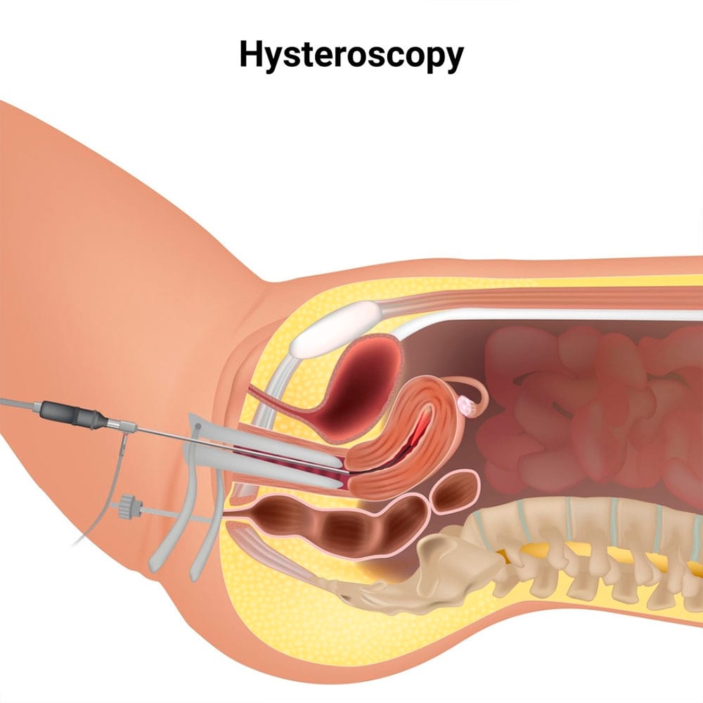 Hysteroscopic Procedures